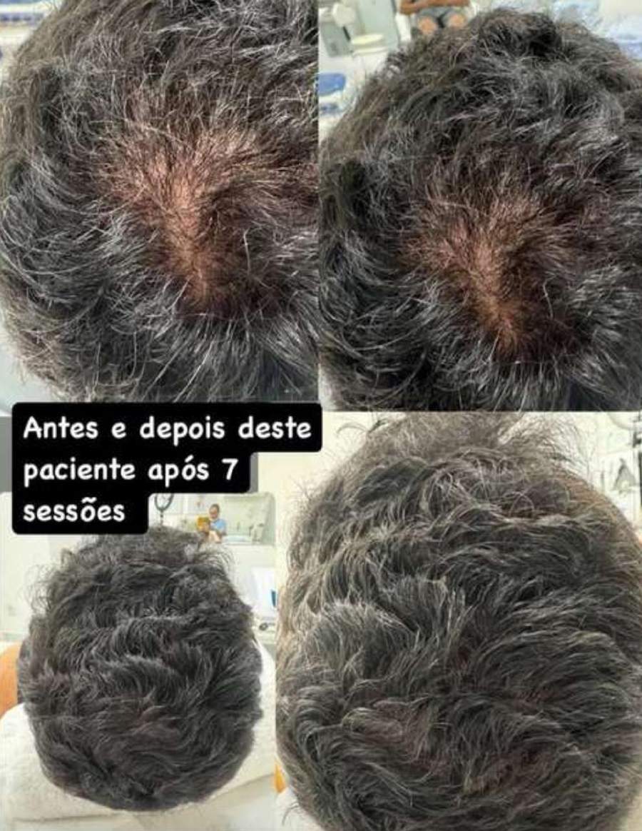 Antes e depois após 7 sessões