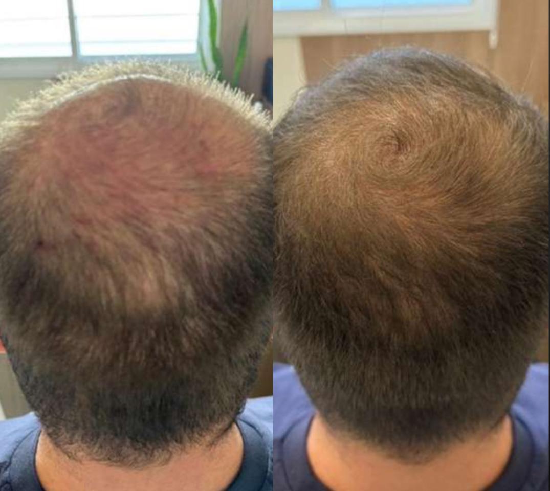 Tratamento oral capilar - resultado