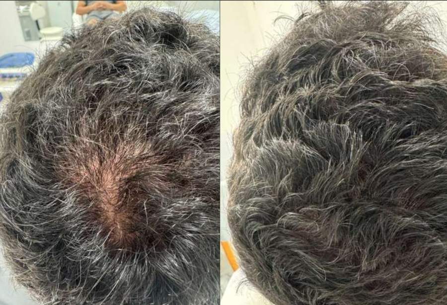 Antes e depois masculino