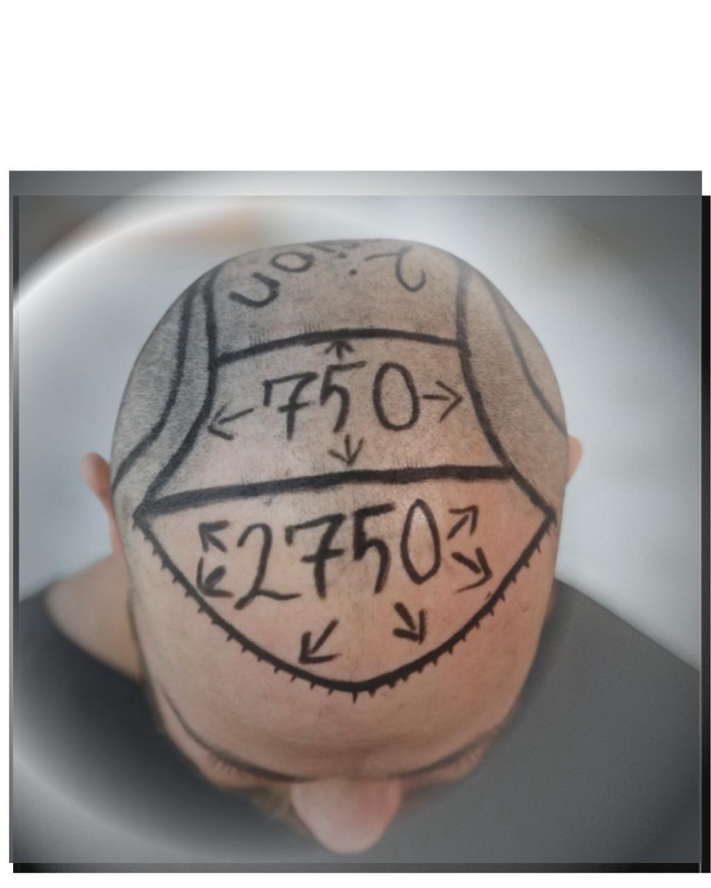 Planejamento de Grafts Capilares