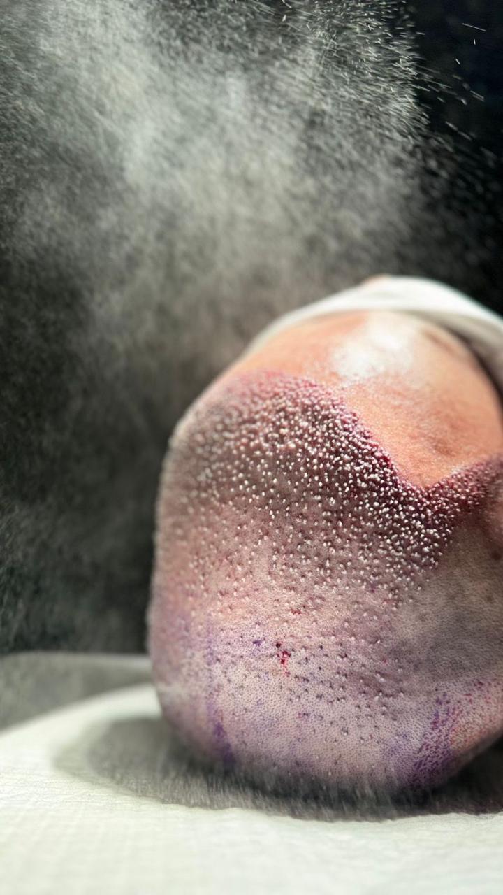 Tratamento PRP capilar