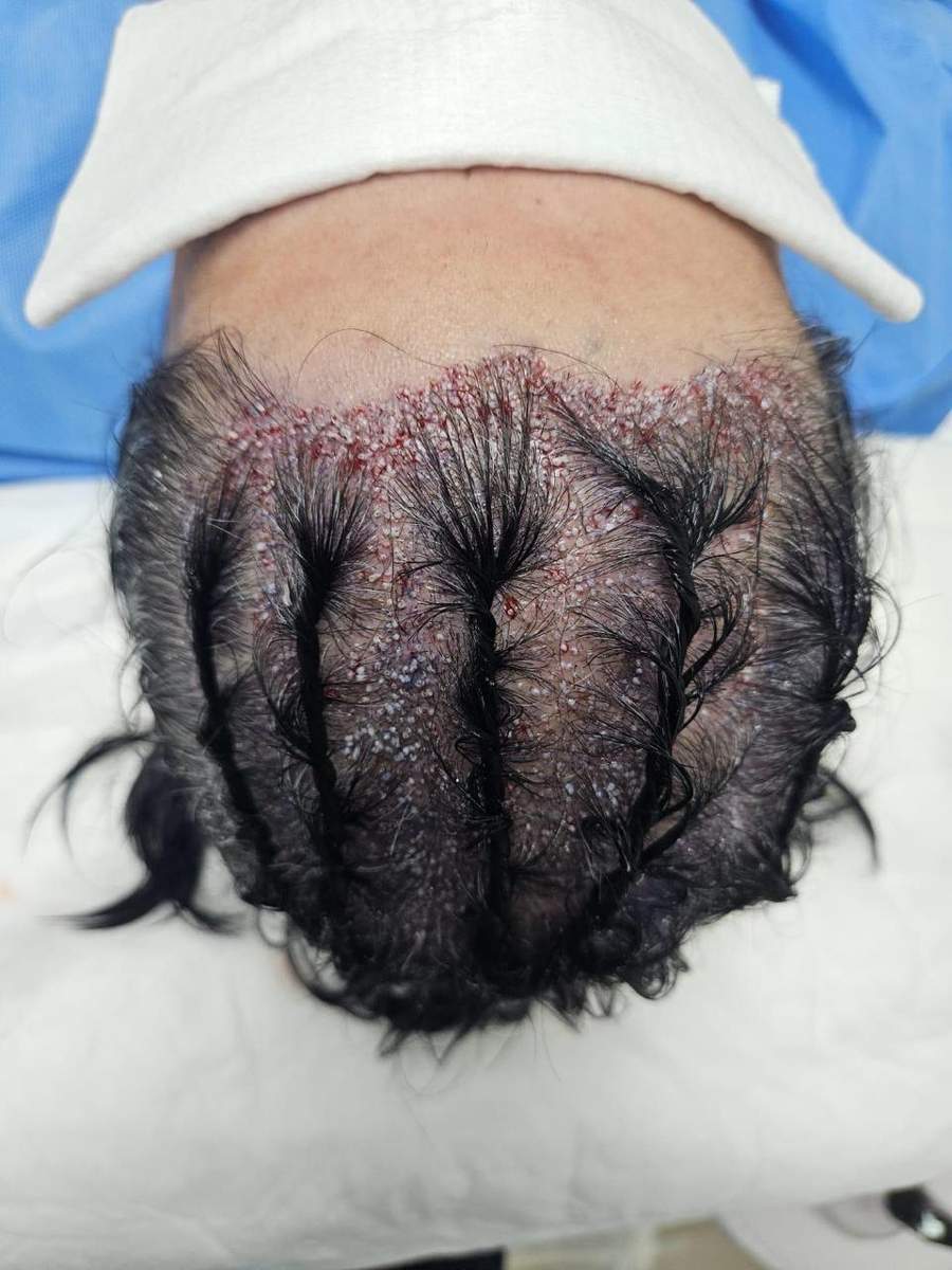 Transplante Capilar FUE - Pós-implante